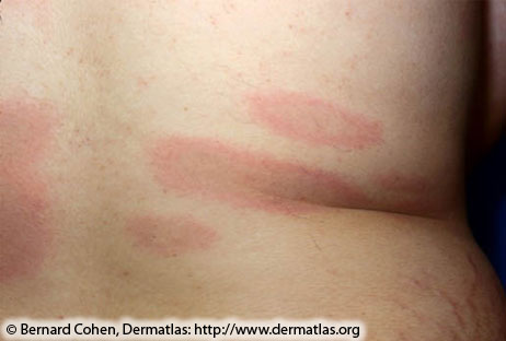 erythema migrans rash 1 010728 from bernard cohen