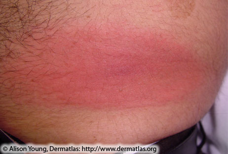 erythema migrans rash 1 050504 provided by alison young