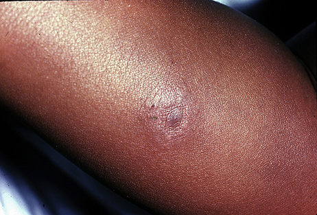 erythema migrans rash file s0190962210008704 from bhate2011